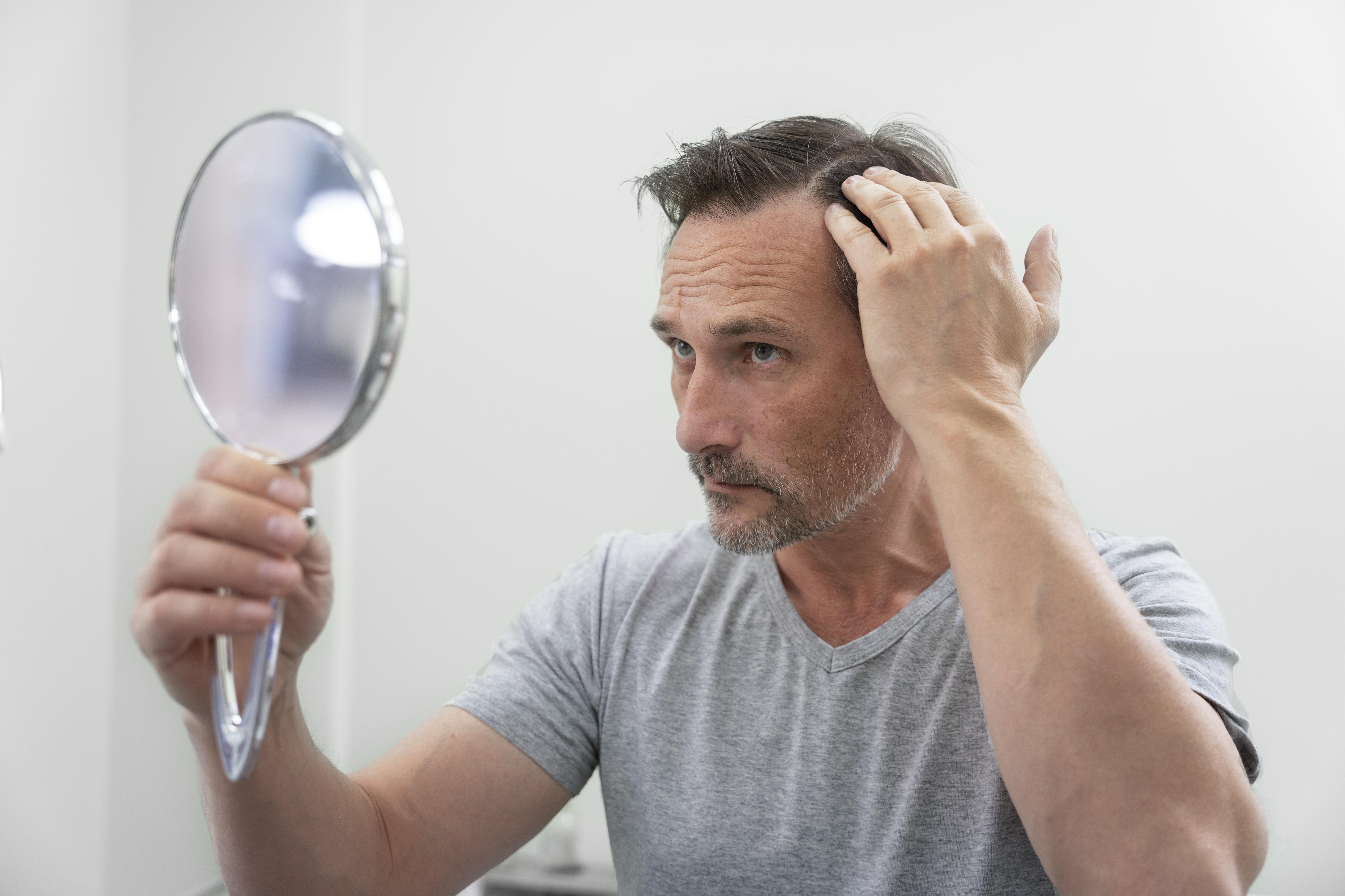 homem sofrendo de queda de cabelo masculino conferindo o cabelo no espelho