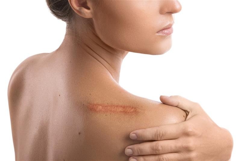 mulher com cicatriz hipertrófica no ombro