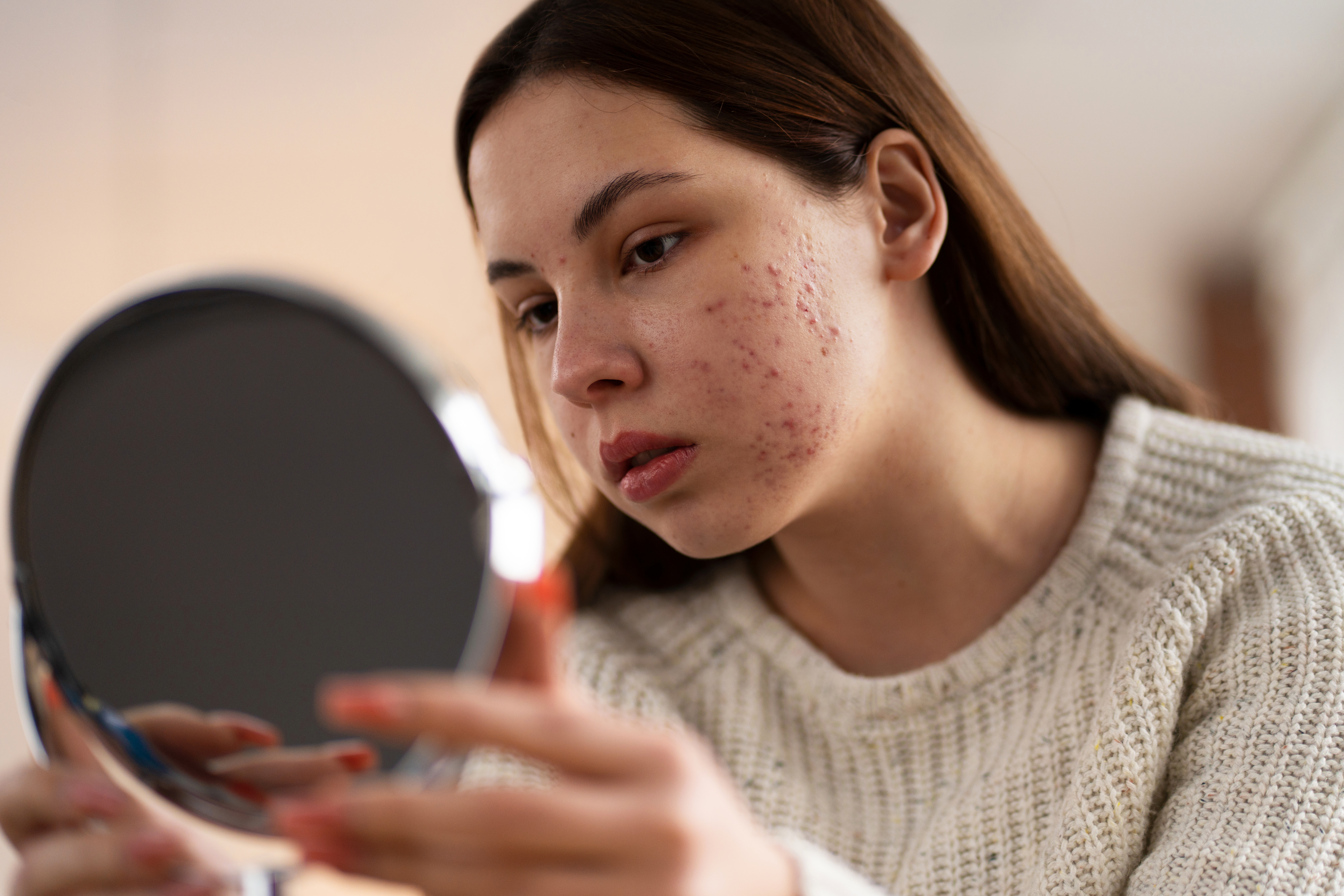 Mulher com acne realizando skincare para pele acneica